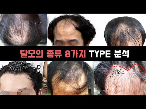 <strong>탈모의</strong> <strong>종류</strong> 8가지 현실적인 대처 방법