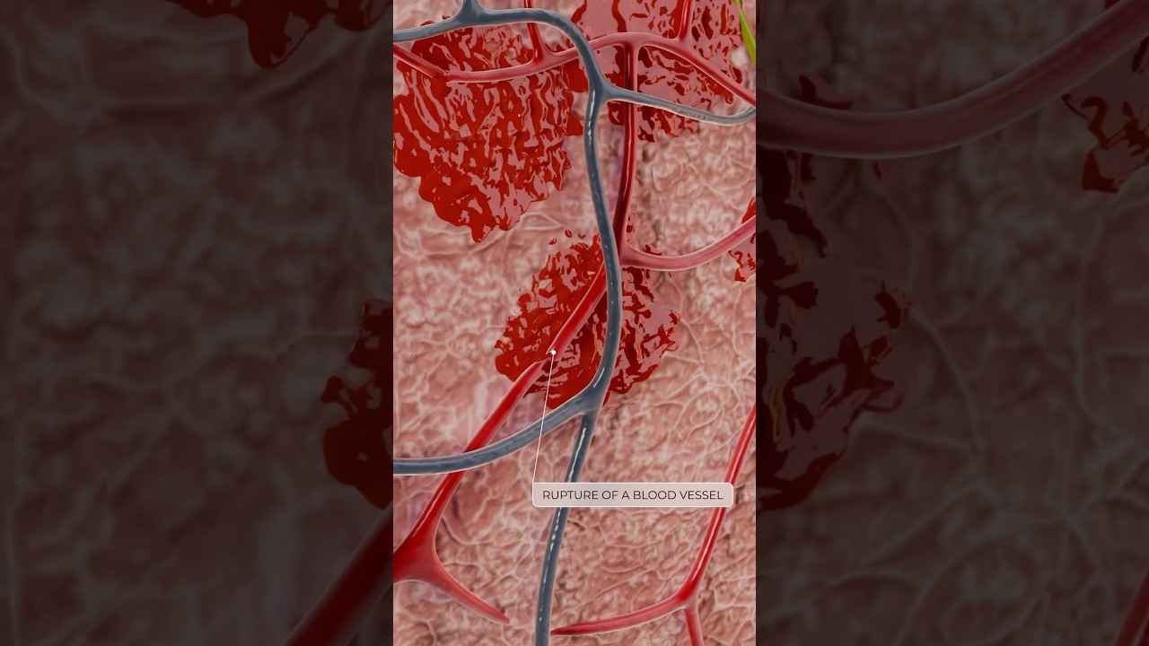 What do vascular hemorrhagic macules reveal about bleeding disorders? Explore in 3D with VOKA
