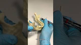 ? Nail Your Inferior Alveolar Blocks   OnlineExodontia com   dentist dentaltips dentalcourses