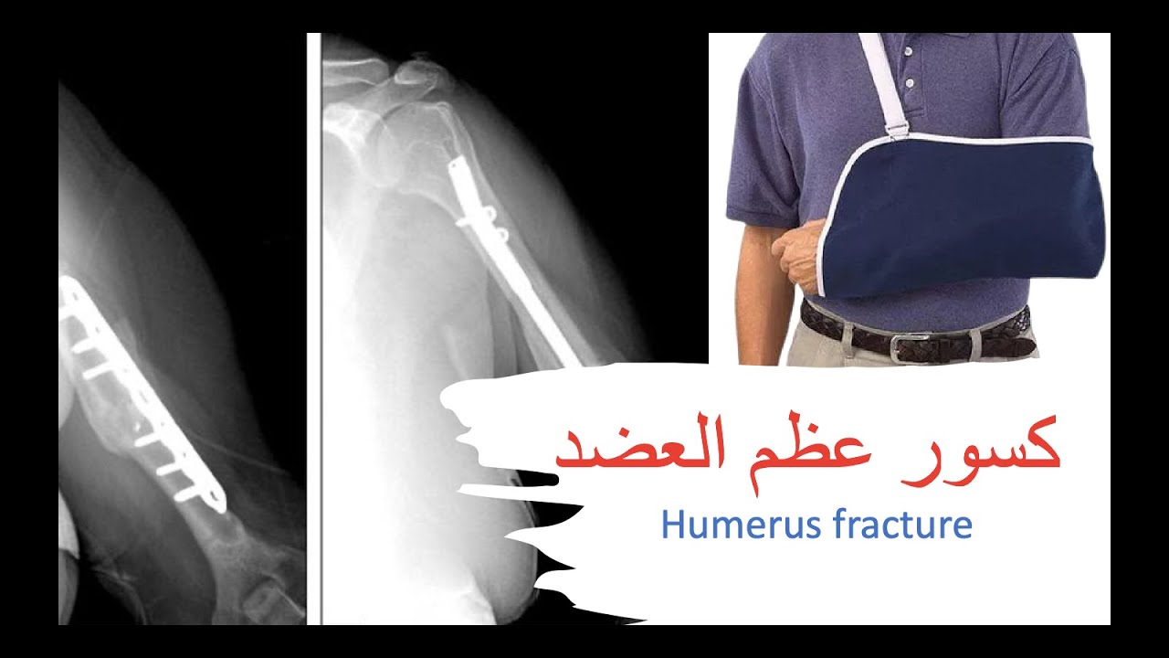 Humerus Fracture / كُسورُ عظم العضد