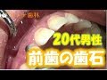 上尾 歯医者 歯周病 20代男性 前歯の歯石取り(歯石除去),Tartar,ตาด,鞑靼　ขูดหินปูน เหงือกบวม