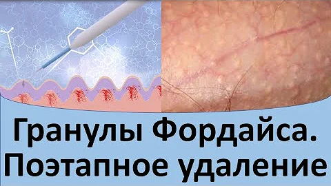 Гранулы Фордайса. Поэтапное удаление.