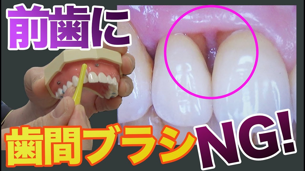 ★ブサイク前歯ページです★ Do not use interdental brushes on your front teeth - Wakayama