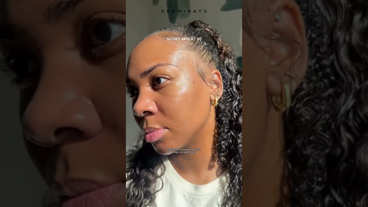 My Skin Is GLOWING After This Laser!!!✨ 