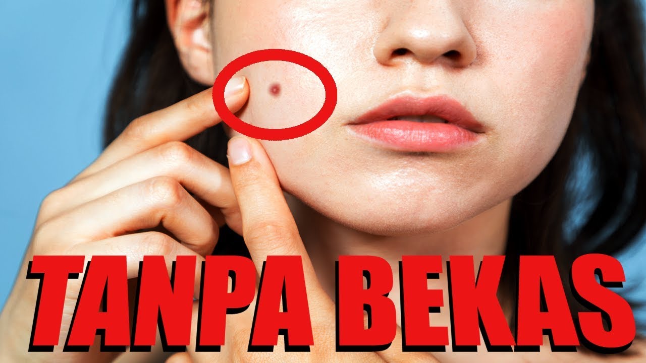 🔴CARA MENGHILANGKAN JERAWAT DENGAN BAHAN BAHAN ALAMI SECARA CEPAT