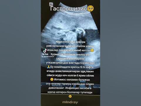 гастрошизис 🥺 #беременность #узи #пороки - YouTube
