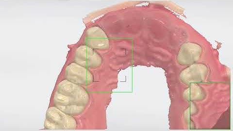 3Shape 트리오스 - 서지컬 가이드 스캔 방법(전치부 결손 케이스) - Scan for Surgical Guides Using TRIOS Anterior Deficiency