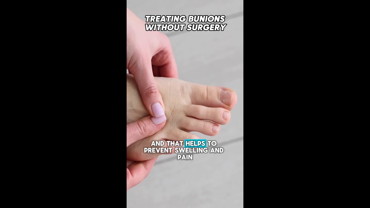 Bunions don’t always mean surgery