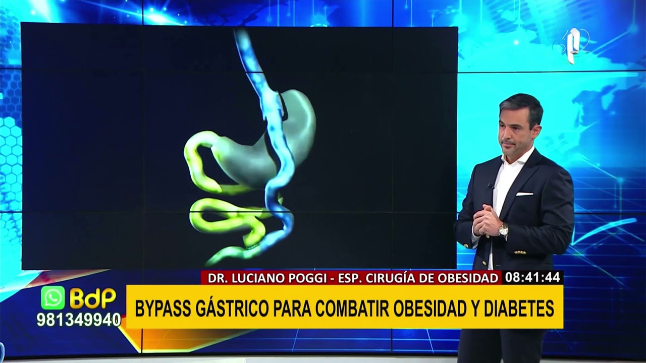 Beneficios del Bypass Gástrico