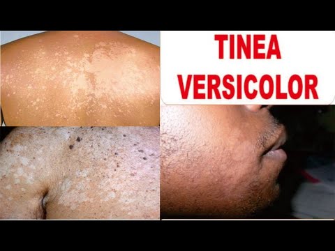 TINEA VERSICOLOR (PANU), Definisi, Penyebab, Gejala dan Cara Pengobatan