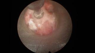 Percutaneous stenoscopic lumbar decompression.