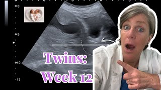 Twins: Week 12 of Pregnancy