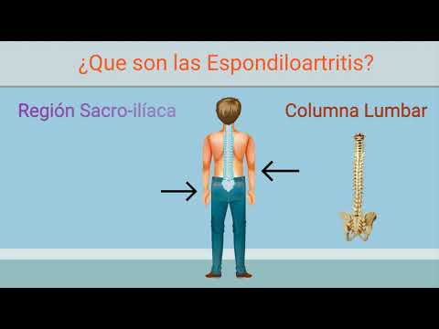 Vídeo: Desarrollos En La Comprensión Científica Y Clínica De Las Espondiloartritis