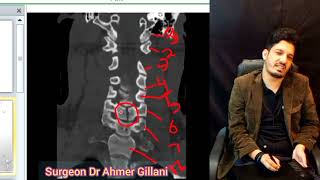 CT Cervical Spine Interpretation Made Ridiculously Simple