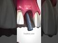 Dental implantsbone graft  dental shorts dentaltreatment twitch youtubeshorts implantfyp