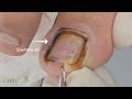 Removi muita onicofose dali - Veja como saiu pele! #satisfying #usa