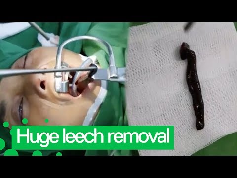 Giant Leech Removed from Woman's Throat