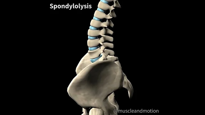 SPONDYLOLYSIS 🧽 - DayDayNews