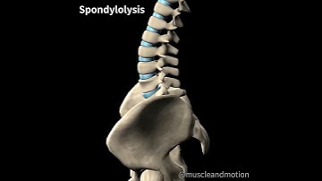 SPONDYLOLYSIS 🧽