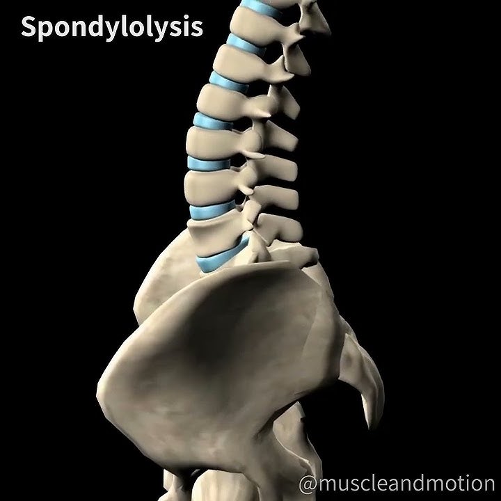 SPONDYLOLYSIS 🧽