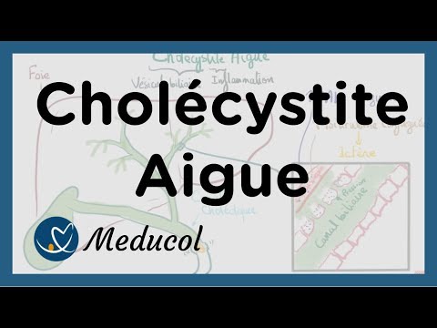 Vidéo: Cholécystite Calculeuse Aiguë Et Chronique