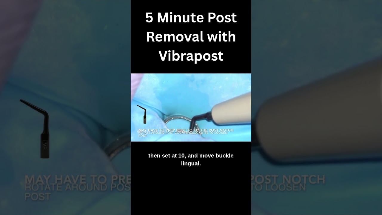 5 Minute Post Removal with Vibrapost