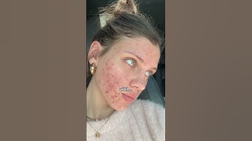 This ONE ingredient fixed my skin when NOTHING else worked ! 🤯 #beeftallow #skincare #acne #fyp