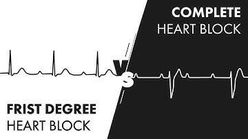 First vs Third Degree Heart Block