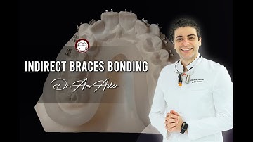Indirect braces bonding step by step by Memosil as a transfer tray in orthodontics by Dr. Amr Asker