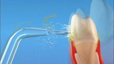 Waterpik Water Flosser   Water Flossing Animation 1