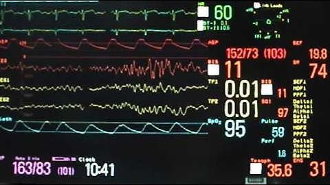 Isoelectricity and Burst Suppression