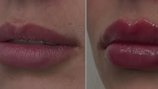 The Cosmetic Fillers Boom: What Are the Side Effects?