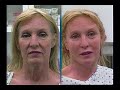 ThreadLift on The Today Show With Dr. Mulholland I SpaMedica TV