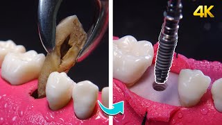 Step-by-step dental implants in 4K