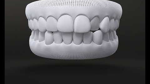 NIỀNG RĂNG KHẤP KHỂNH