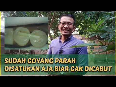 Perawatan gigi goyang yang seharusnya dicabut