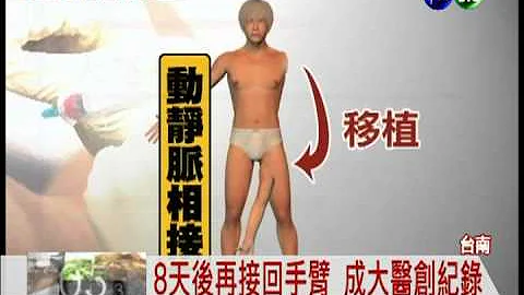 断臂移植大腿再接回 全球首例! - 天天要闻
