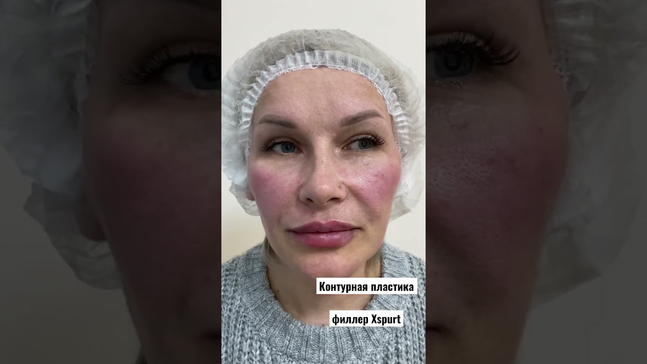 Контурная пластика. Филлер ГК XSPURT.