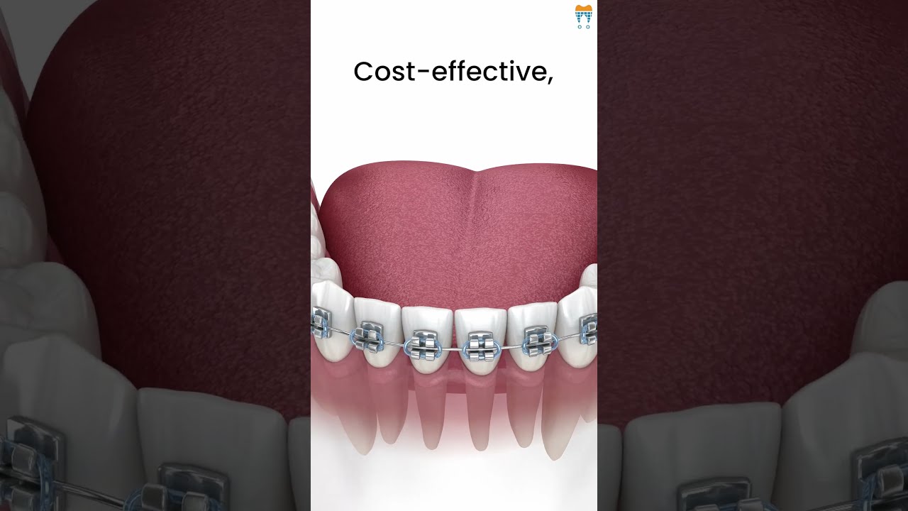 Ceramic Vs Metal Braces Which Should You Choose Shorts Dentistry Teeth Explore