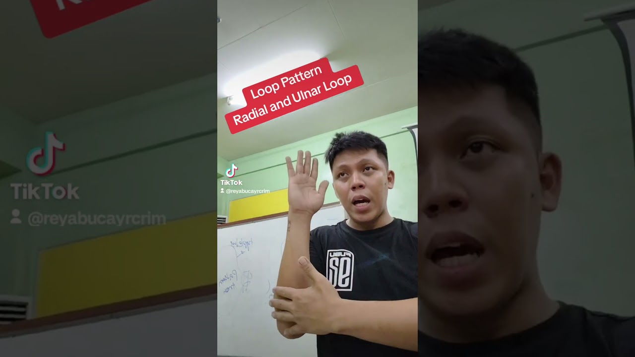 Loop Pattern Radial and Ulnar Loop