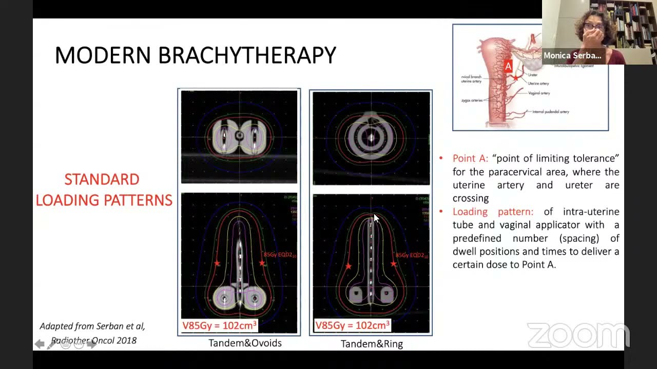 NSS 2021.07.09 - Monica Serban "Brachytherapy in the treatment of cervical cancer"