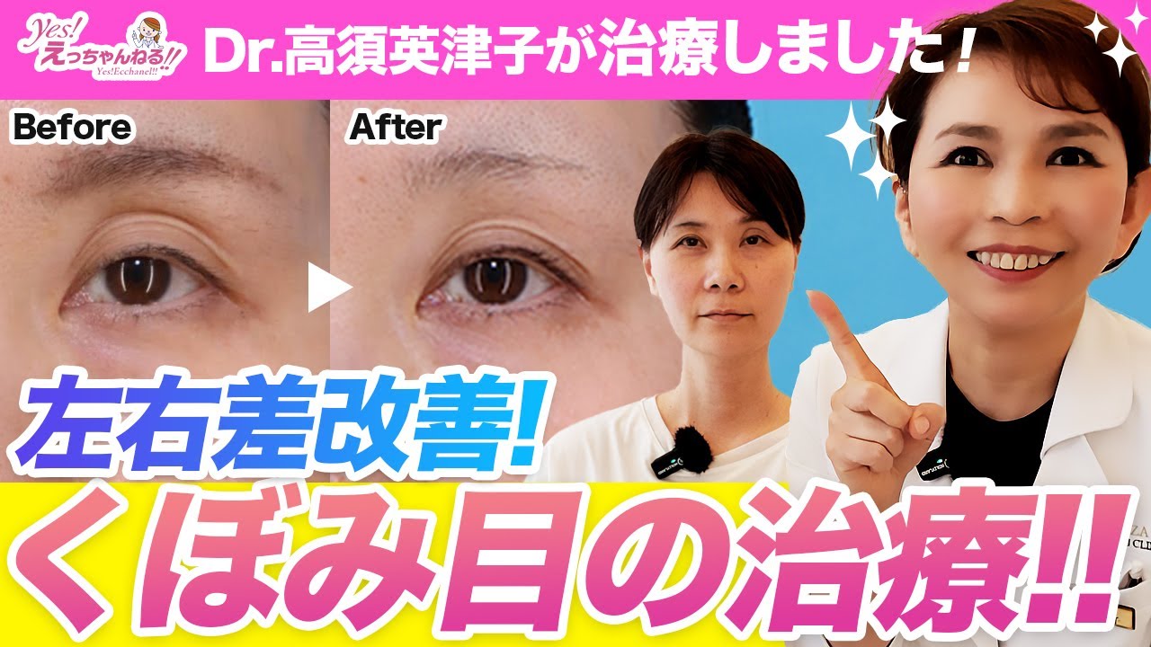 左右差改善！高須クリニックのくぼみ目治療をご紹介します【ヒアルロン酸】