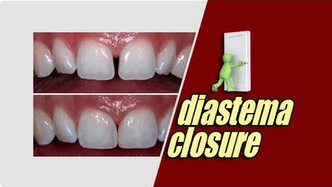 Diastema Closure with composite: Free-Hand Technique Step-by-Step