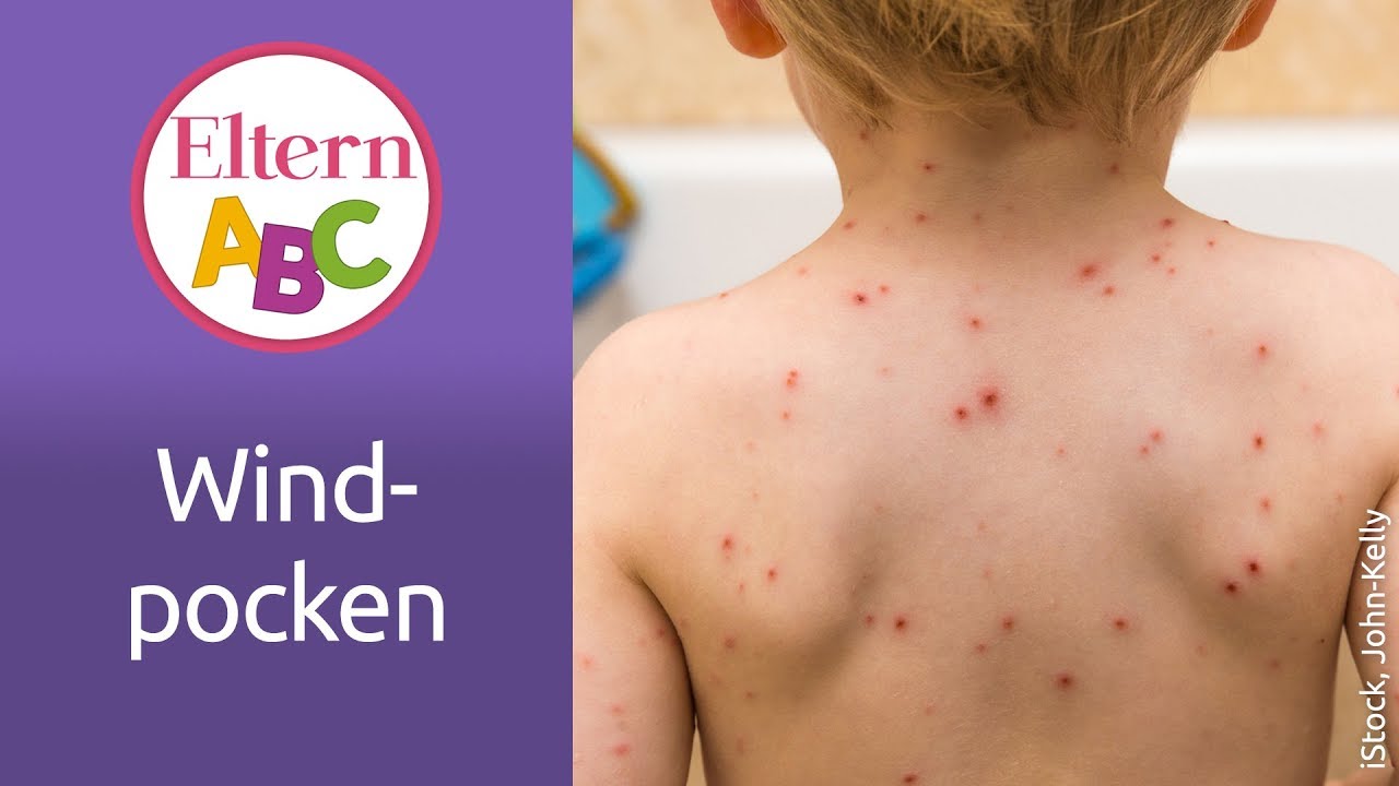 Windpocken | Baby | Eltern ABC | ELTERN | Elternratgeber