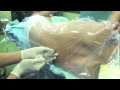胸部硬膜外麻酔 Th8/9 epidural anesthesia by Dr.EpiCal