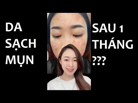 Da Sạch Mụn Sau 1 Tháng Nhờ Sản Phẩm Trị Mụn S-Skin mới nhất 2023