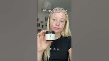 From hiding to GLOWING! only this one product could heal me #acne #viral #skincare #beeftallow #glow