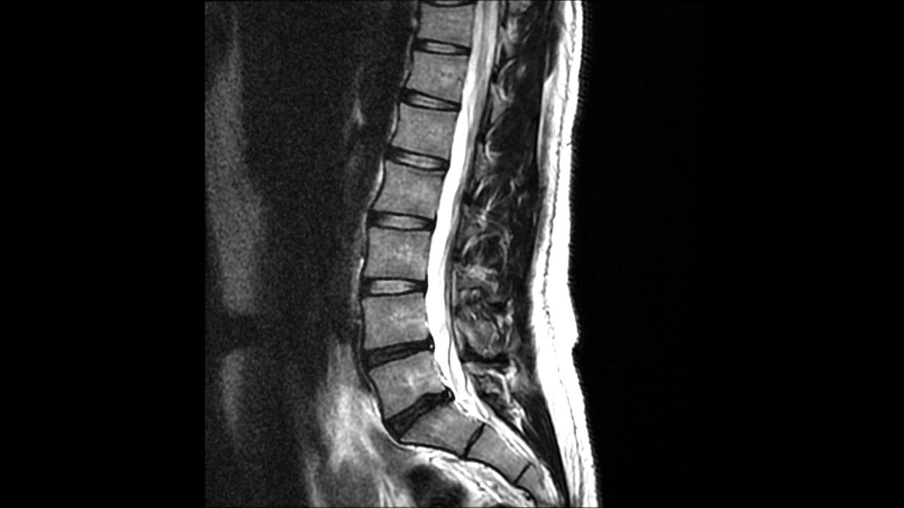 Lumber MRI Degenerative Disc Disease With Herniation... Please Help