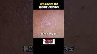 리팟 후 듀오덤 떼고 붉은기가 남아있어요?! #검버섯없애기 #잡티없애기 #리팟레이저부작용