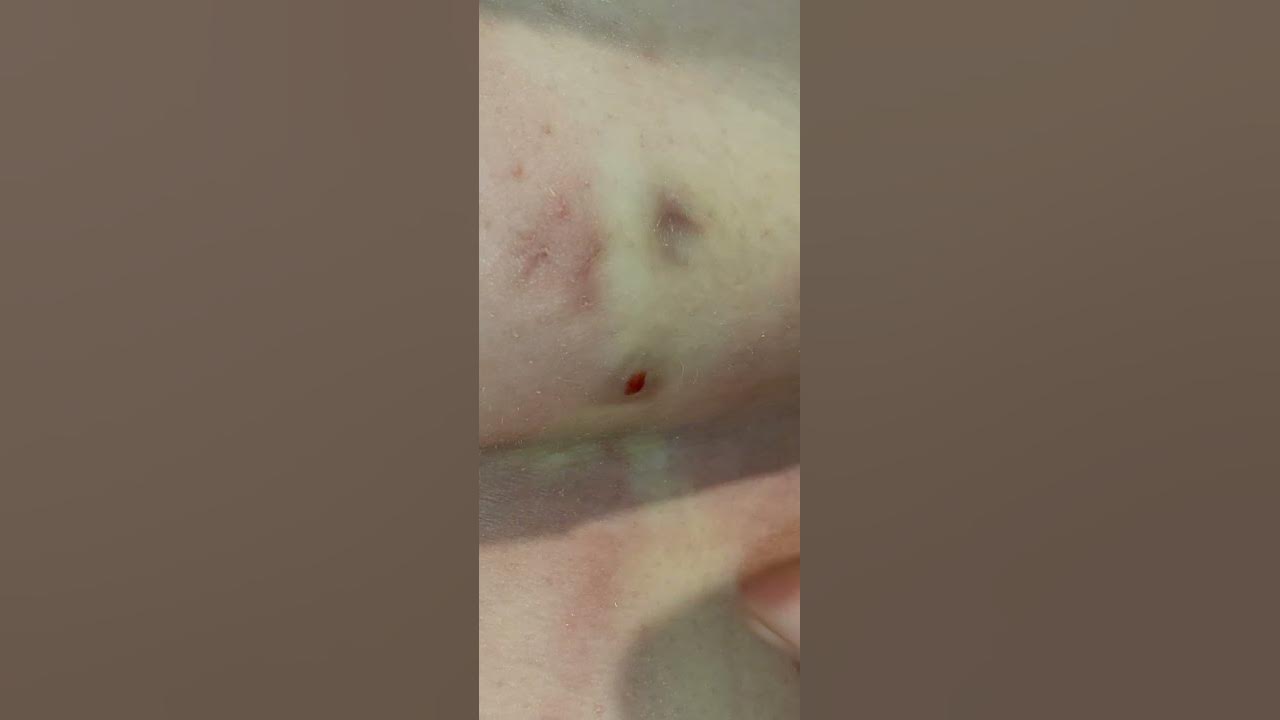 Boils & pimples exploding!! YouTube